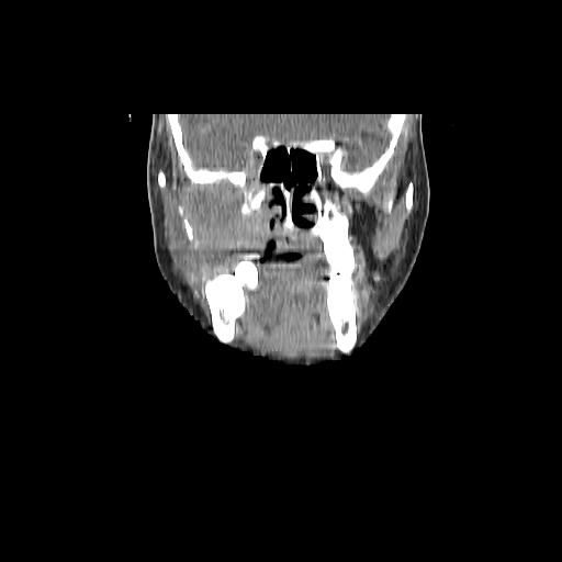 Carcinoma of the maxillary antrum (Radiopaedia 53805-59888 Coronal C+ delayed 55).jpg