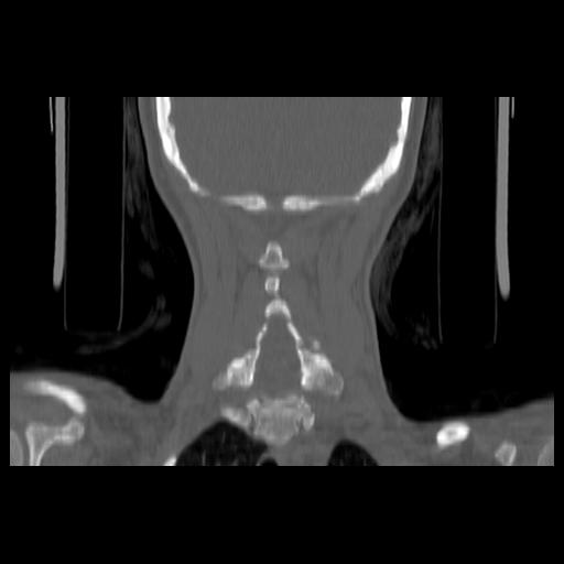 Carcinoma of the maxillary antrum (Radiopaedia 53805-59888 Coronal bone window 122).jpg