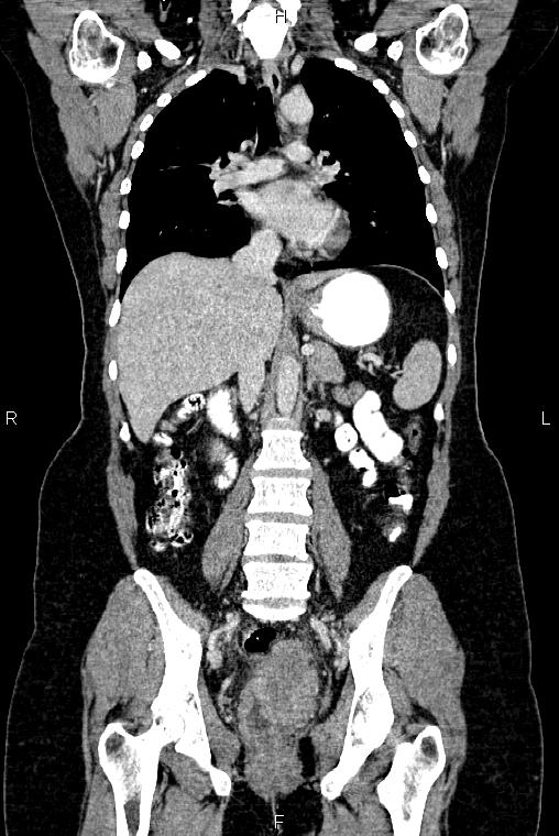 Carcinoma of uterine cervix (Radiopaedia 85861-101700 C 31).jpg