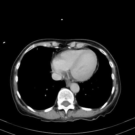 Carcinosarcoma (Radiopaedia 70401-80503 A 2).jpg