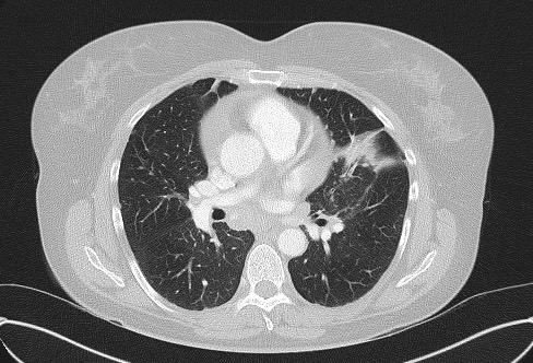 File:Cardiac sarcoidosis (Radiopaedia 74548-85534 Axial lung window 41).jpg