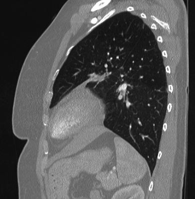 File:Cardiac sarcoidosis (Radiopaedia 74548-85534 Sagittal lung window 24).jpg