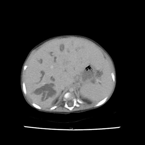 Caroli disease with autosomal recessive polycystic kidney disease (ARPKD) (Radiopaedia 89651-106703 B 48).jpg