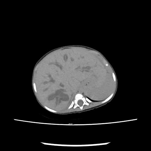 File:Caroli disease with autosomal recessive polycystic kidney disease (ARPKD) (Radiopaedia 89651-106703 E 45).jpg