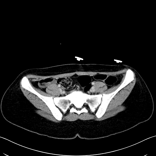 Caroli disease with medullary sponge kidney (Radiopaedia 82622-96804 C 57).jpg