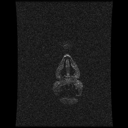 Carotid arterial dissection with acute cerebral infarction (Radiopaedia 26636-26784 MRV 161).jpg