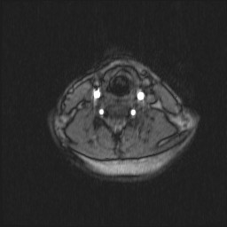 Carotid artery dissection (Radiopaedia 28441-28689 Axial MRA 33).jpg