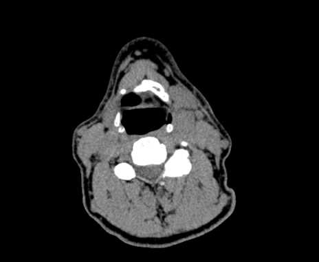 File:Carotid body tumor (Radiopaedia 61750-69757 Axial non-contrast 57).jpg