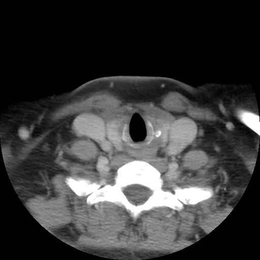 Carotid body tumor (paraganglioma) (Radiopaedia 38586-40729 A 26).jpg