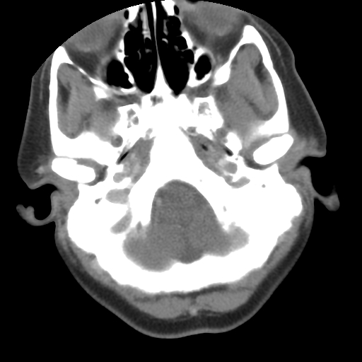 Carotid body tumor (paraganglioma) (Radiopaedia 38586-40729 A 5).jpg