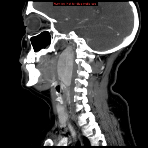 File:Carotid body tumor with lung metastases (Radiopaedia 9301-9986 Sagittal C+ delayed 32).jpg