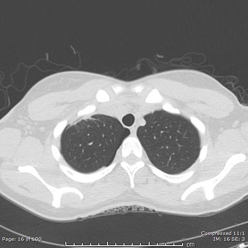 Catamenial pneumothorax (Radiopaedia 54382-60600 Axial non-contrast 16).jpg