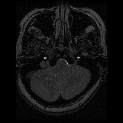 Cavernoma, DVA and right ICA aneurysm (Radiopaedia 33890-35072 E 94).png