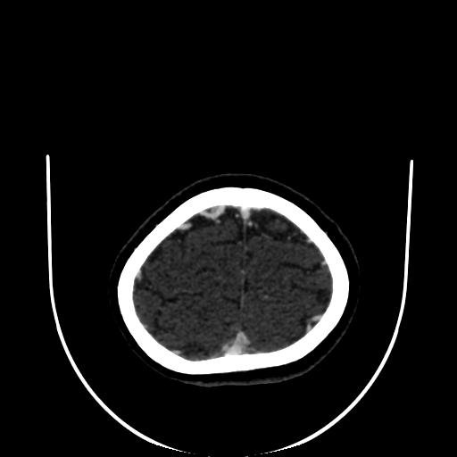 Cavernoma with developmental venous anomaly (Radiopaedia 22470-22506 C 176).jpg