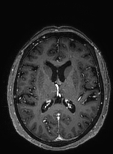 Cavernous hemangioma of the cerebellar falx (Radiopaedia 73025-83724 Axial T1 C+ 150).jpg