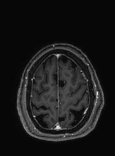 Cavernous hemangioma of the cerebellar falx (Radiopaedia 73025-83724 Axial T1 C+ 59).jpg