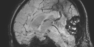 File:Cavernous hemangioma of the cerebellar falx (Radiopaedia 73025-83724 Sagittal BOLD 103).jpg