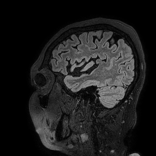 Cavernous hemangioma of the cerebellar falx (Radiopaedia 73025-83724 Sagittal FLAIR 176).jpg