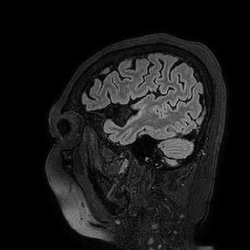 Cavernous hemangioma of the cerebellar falx (Radiopaedia 73025-83724 Sagittal FLAIR 29).jpg