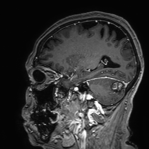Cavernous hemangioma of the cerebellar falx (Radiopaedia 73025-83724 Sagittal T1 C+ 143).jpg
