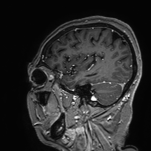 Cavernous hemangioma of the cerebellar falx (Radiopaedia 73025-83724 Sagittal T1 C+ 161).jpg