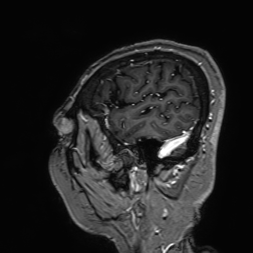 Cavernous hemangioma of the cerebellar falx (Radiopaedia 73025-83724 Sagittal T1 C+ 30).jpg