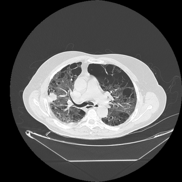 Cavitating bronchogenic carcinoma (Radiopaedia 44489-48162 Axial lung window 32).jpg