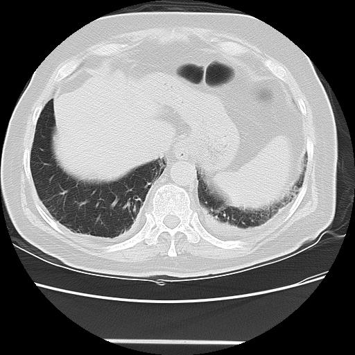 Cavitating pulmonary metastases (Radiopaedia 89545-106544 Axial lung window 47).jpg