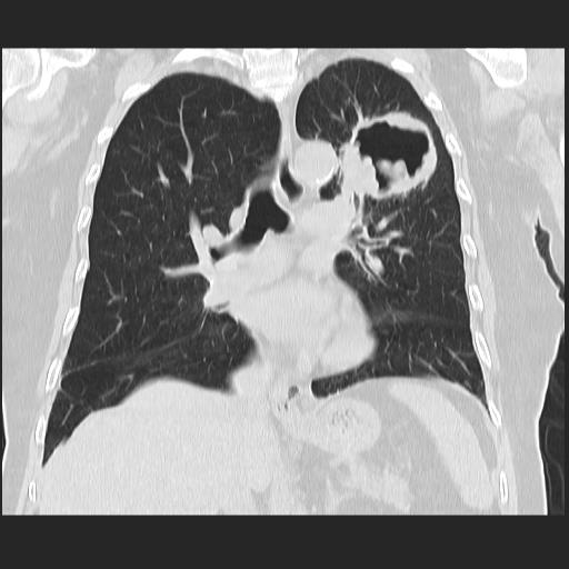 File:Cavitating pulmonary metastases (Radiopaedia 89545-106544 Coronal lung window 23).jpg