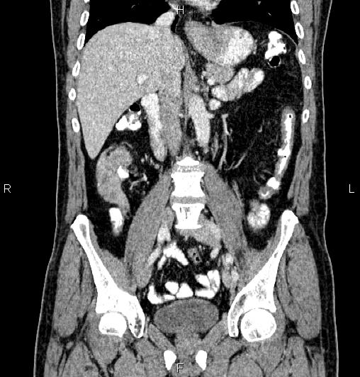 Cecal adenocarcinoma (Radiopaedia 85324-100916 D 33).jpg