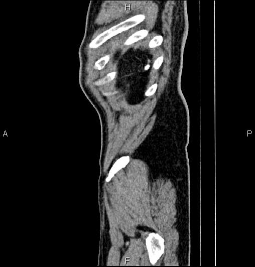 Cecal adenocarcinoma (Radiopaedia 85324-100916 E 91).jpg