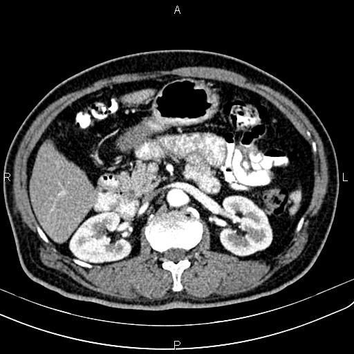 Cecal cancer with appendiceal mucocele (Radiopaedia 91080-108651 A 79).jpg