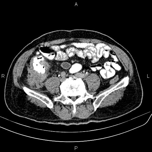 File:Cecal cancer with appendiceal mucocele (Radiopaedia 91080-108651 Axial C+ delayed 50).jpg