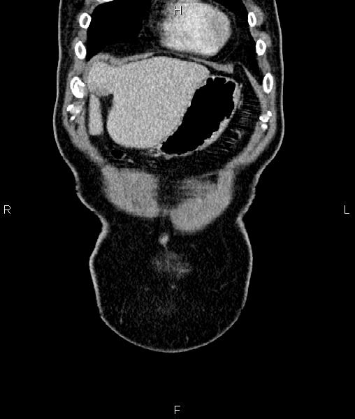 Cecal cancer with appendiceal mucocele (Radiopaedia 91080-108651 D 8).jpg