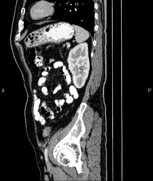 File:Cecal cancer with appendiceal mucocele (Radiopaedia 91080-108651 E 74).jpg