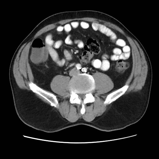Cecal mass causing appendicitis (Radiopaedia 59207-66531 A 54).jpg