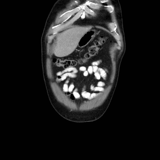File:Cecal mass causing appendicitis (Radiopaedia 59207-66531 B 6).jpg
