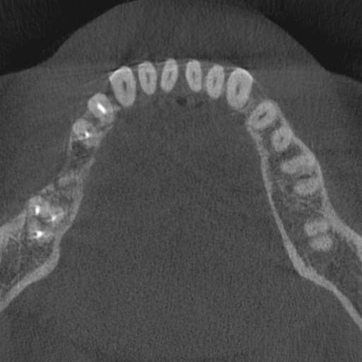 Cemento-osseous dysplasia (Radiopaedia 48251-53126 Axial non-contrast 44).jpg