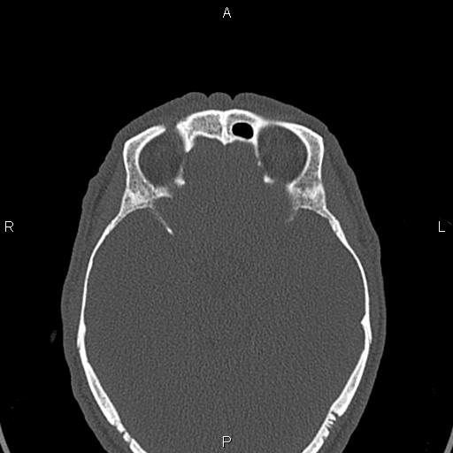 Central giant cell granuloma (Radiopaedia 83346-97761 Axial bone window 69).jpg
