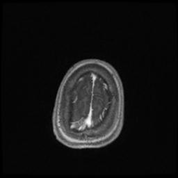 Central neurocytoma (Radiopaedia 30220-30842 Axial T1 C+ 139).jpg