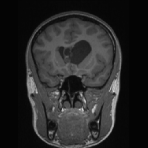 Central neurocytoma (Radiopaedia 37664-39557 Coronal T1 60).png