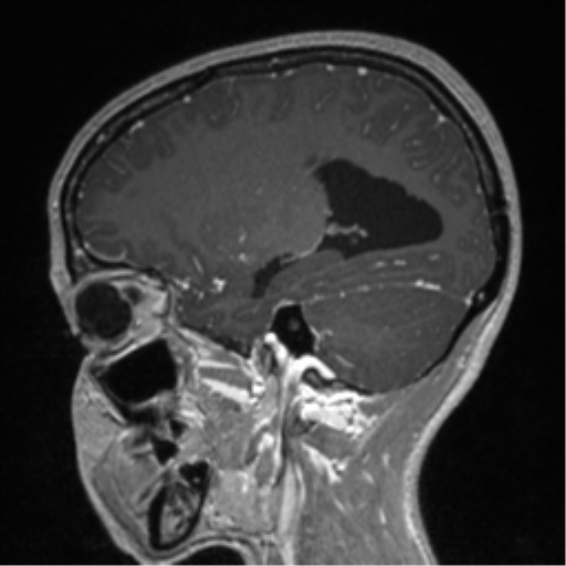 Central neurocytoma (Radiopaedia 37664-39557 Sagittal T1 C+ 32).png