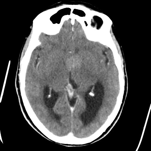 Central neurocytoma (Radiopaedia 65317-74346 Axial C+ delayed 23).png