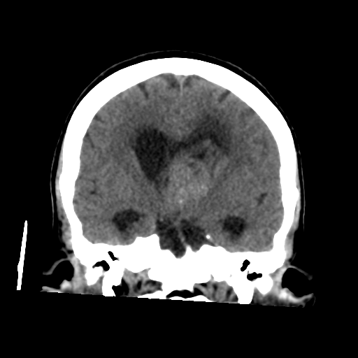 File:Central neurocytoma (Radiopaedia 65317-74346 Coronal non-contrast 29).png