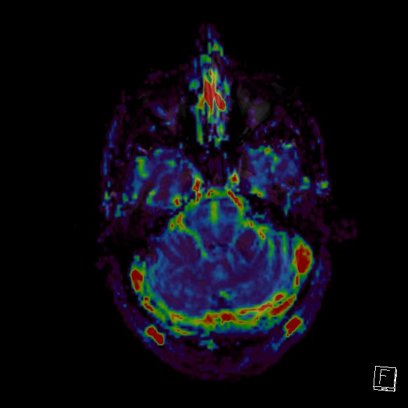 Central neurocytoma (Radiopaedia 84497-99872 Axial Perfusion 240).jpg