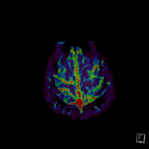Central neurocytoma (Radiopaedia 84497-99872 Axial Perfusion 26).jpg