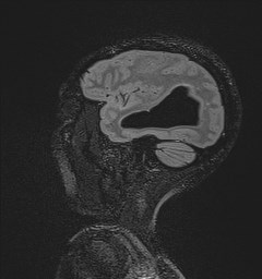 Central neurocytoma (Radiopaedia 84497-99872 Sagittal Flair + Gd 120).jpg