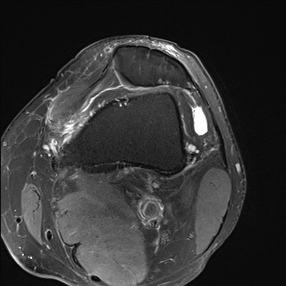 File:Central osteophyte (Radiopaedia 72592-83151 Axial PD fat sat 5).jpg
