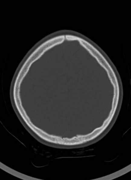 Cerebellar abscess (Radiopaedia 73727-84527 Axial bone window 54).jpg