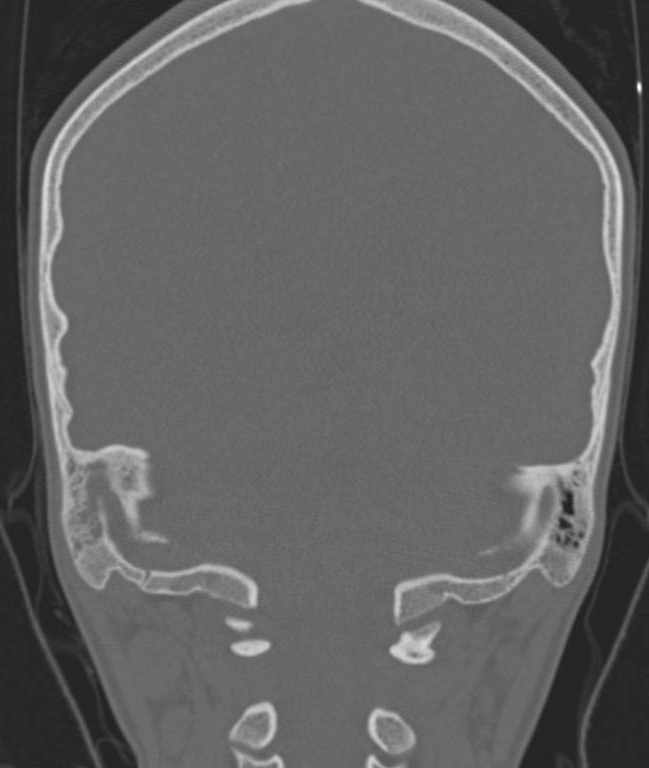 Cerebellar abscess (Radiopaedia 73727-84527 Coronal bone window 32).jpg
